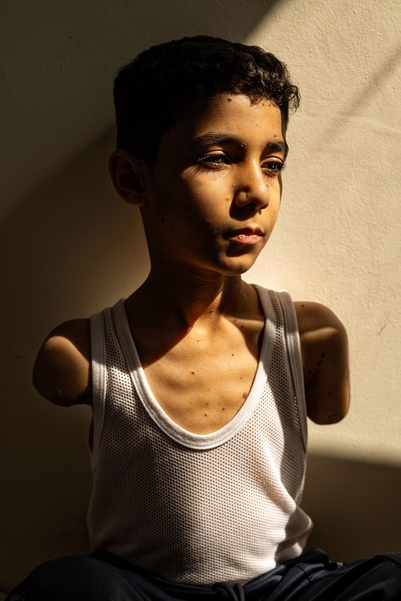 World Press Photo of the Year - Mahmoud Ajjour, Aged Nine © Samar Abu Elouf, The New York Times.